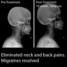 Load image into Gallery viewer, Cervigard Forward Head Posture Neck Collar